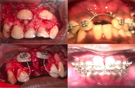Case Study 05 — before and after orthodontic treatment