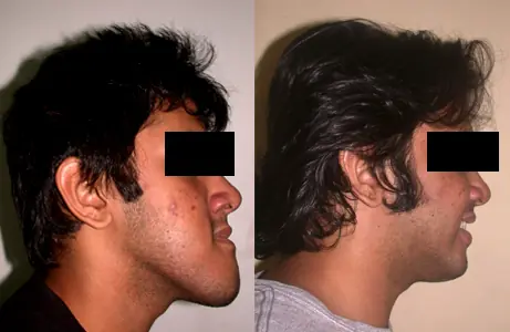 Case Study 06 — before and after orthodontic treatment