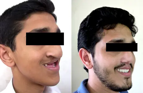 Case Study 10 — before and after orthodontic treatment