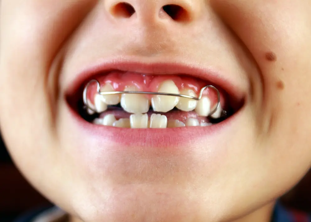 Crowding Management in Orthodontics