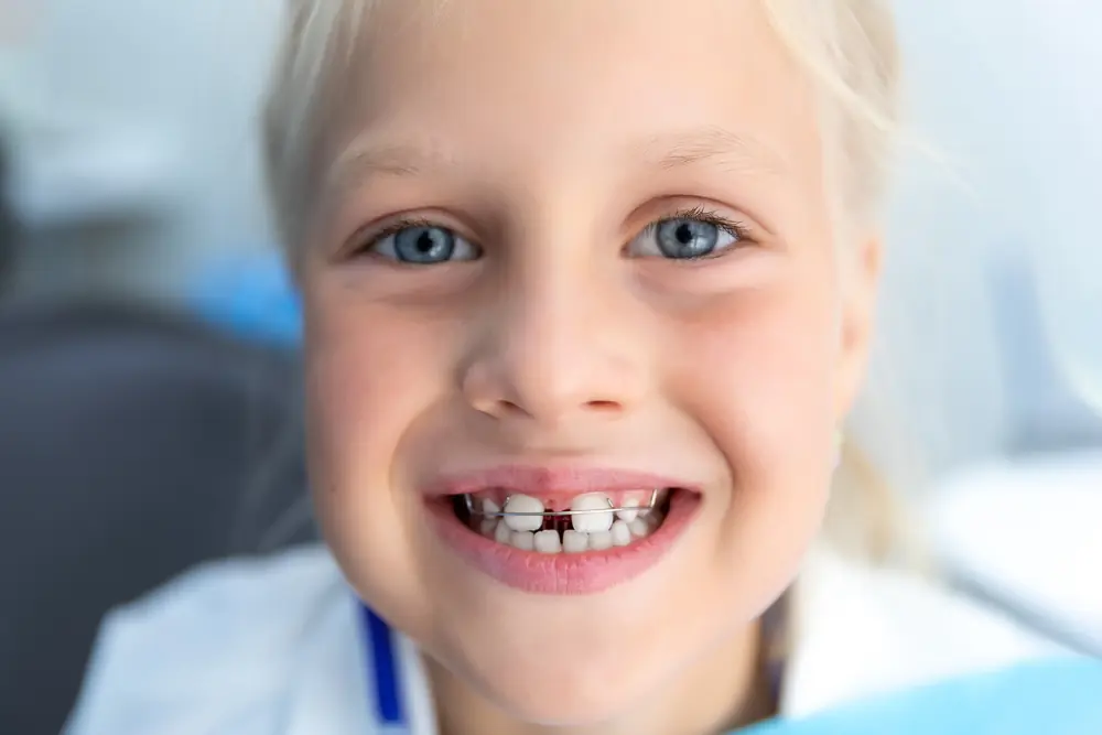 Hypodontia and Orthodontics: How Braces Can Help Missing Teet