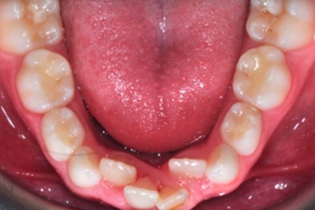 Interceptive Management of Lower Incisor Crowding in Children